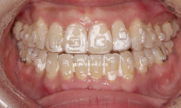 양악수술 선수술 교정 후기 인비절라인 교정 관련 이미지 8