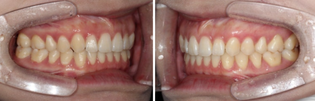 If Inward-Tilted Teeth Make Your Smile Look Constricted? Invisalign Before and After image 10