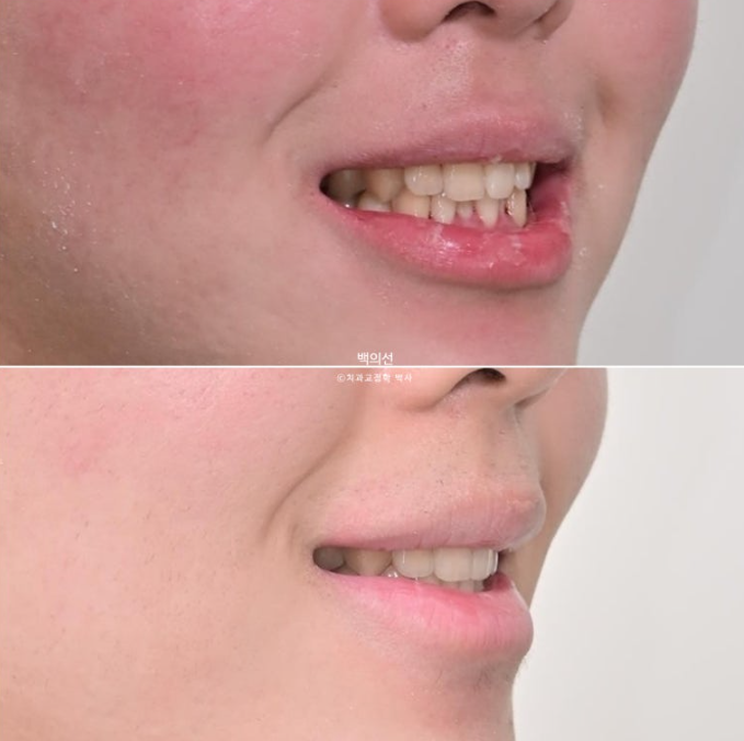 유학생 교정 인비절라인 라이트 치료기간 5개월 관련 이미지 17