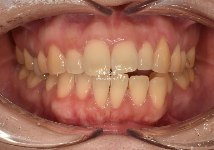 비발치 인비절라인 교정 편측 개방교합 가위교합 돌출 재교정 관련 이미지 2