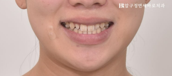 왜소치 인비절라인 라이트 교정 / 무삭제 라미네이트 젤라미 관련 이미지 6