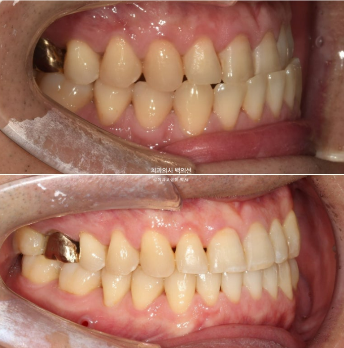 40대 인비절라인 비수술 비발치 주걱턱 비대칭 교정 관련 이미지 14