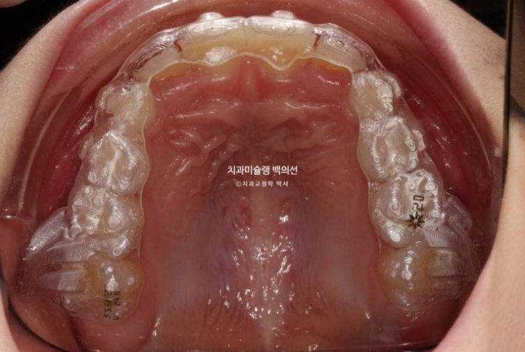 어린이 무턱 성장교정 덧니 인비절라인 퍼스트 악궁확장 치료기간 2년 관련 이미지 15