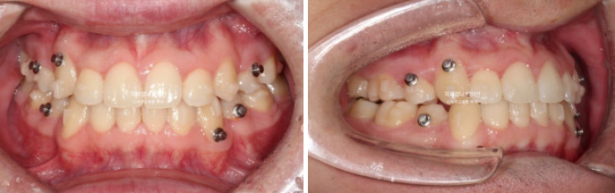 투명교정 인비절라인 덧니 교정 치료기간 알아보기 관련 이미지 6