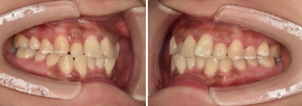 Invisalign Success Depends on Wearing Them Consistently|9-Month Real Treatment Case of Crowding & Underbite image 3