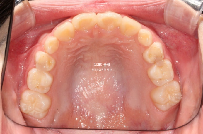 어린이 투명교정 인비절라인 퍼스트 과개교합 교정 후기 관련 이미지 16