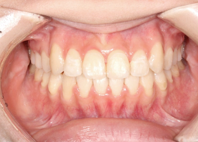 비발치 덧니교정 인비절라인 교정 사랑니 이용 교정 관련 이미지 13