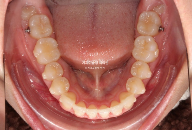 비발치 인비절라인 교정 돌출입 교정 후기 관련 이미지 13