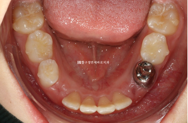 소아 투명교정 인비절라인 퍼스트 후기 기록 관련 이미지 8