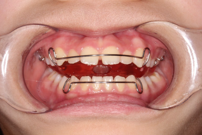 소아 비대칭 교정 인비절라인 퍼스트 재제작 1회 MA 치료 관련 이미지 1