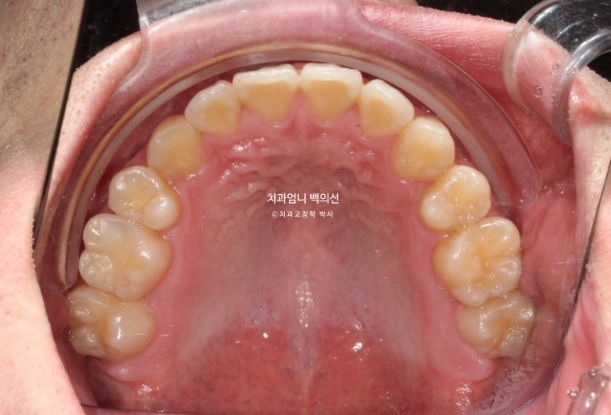 투명교정 인비절라인 덧니 교정 치료기간 알아보기 관련 이미지 10