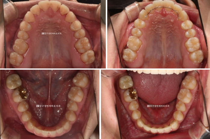 양악수술 교정 인비절라인 주걱턱 교정 치료 후기 관련 이미지 9