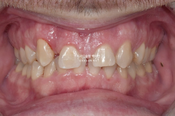 앞니 선천적 결손 인비절라인 임플란트 과개교합 치료 기간 관련 이미지 2
