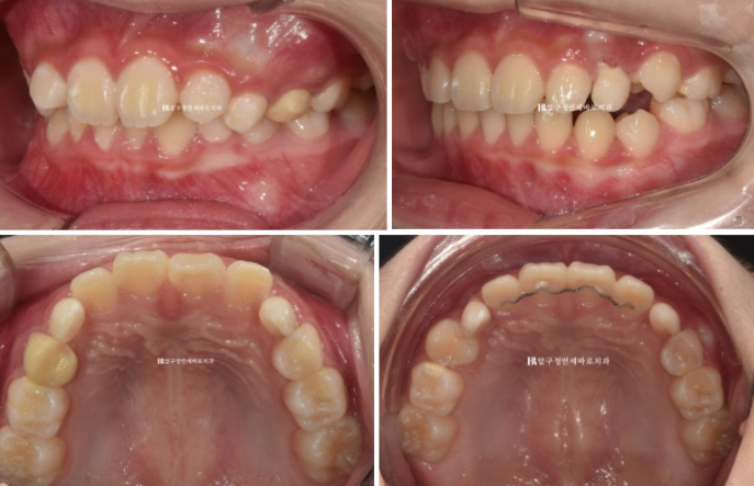 어린이교정 투명교정 인비절라인 퍼스트 후기 관련 이미지 4