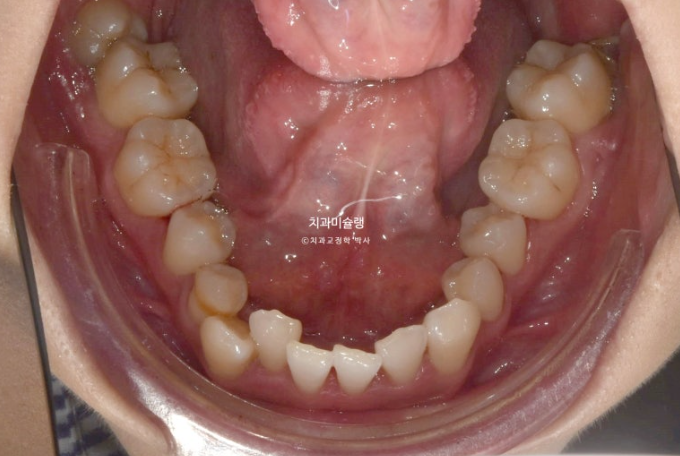 인비절라인 비발치 제2대구치 발치 사랑니 대체 교정 심한 덧니 교정 치료 관련 이미지 6