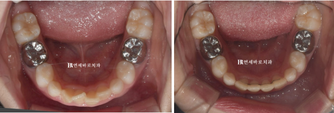 A Real Case of Preventing Crowded Teeth with Invisalign First for a Child in Gangnam image 7