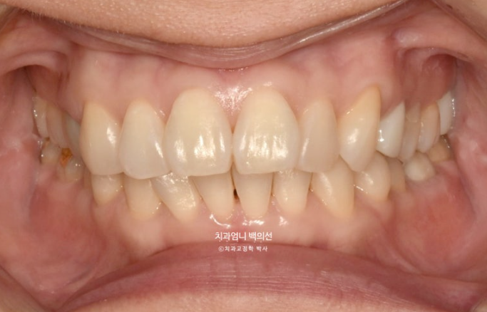 50대 캔팅 교합평면 기울어짐 덧니 교정 인비절라인 라이트 교정? 관련 이미지 1