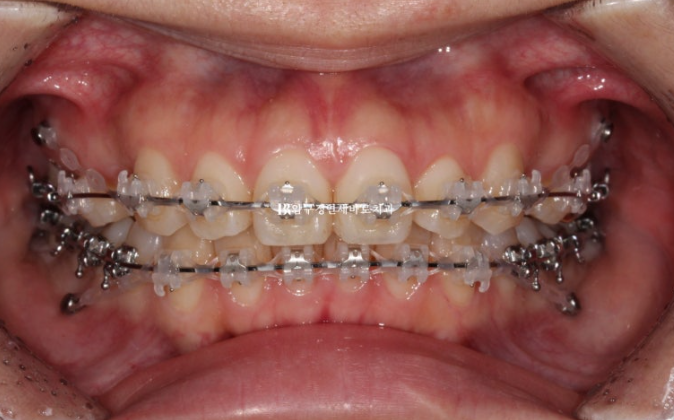 Gummy Smile Correction, Gummy Smile Orthodontics, Rabbit Teeth Correction image 5