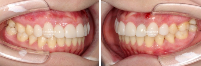 잇몸미소 인비절라인 거미스마일 토끼이빨 교정 무삭제 라미네이트 반대교합 치료 후기 관련 이미지 16