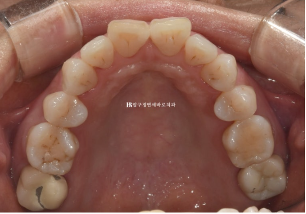 Can Invisalign Lite Work for People in Their 50s? A Real Middle-Aged Orthodontic Case Improving Butterfly Teeth and Gum Recession image 5
