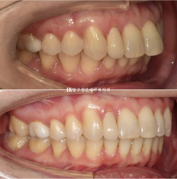 Can Invisalign Lite Work for Patients in Their 40s? A Real Case Improving Scissor Bite and Deep Bite in 10 Months image 1