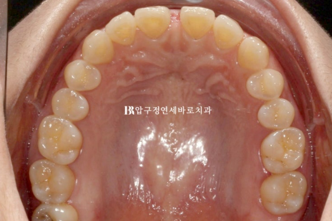 벌어진 치아 교정 인비절라인 라이트 무삭제 라미네이트 치료 관련 이미지 5