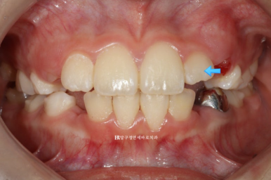 소아 투명교정 인비절라인 퍼스트 후기 기록 관련 이미지 5