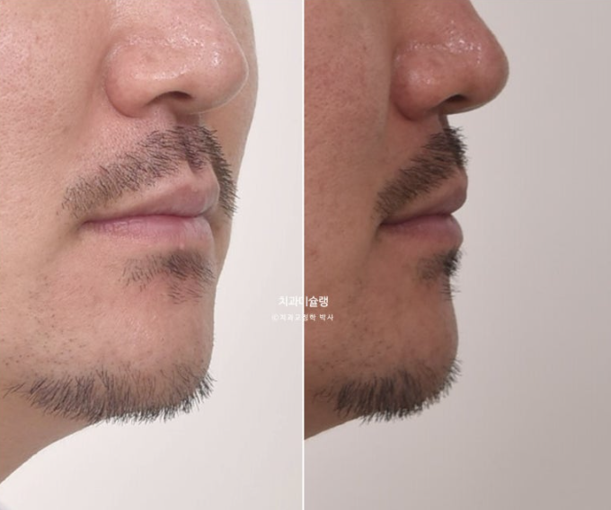 30대 MSE 악궁확장 덧니 반대교합 비발치 클리피씨 부작용 관련 이미지 5