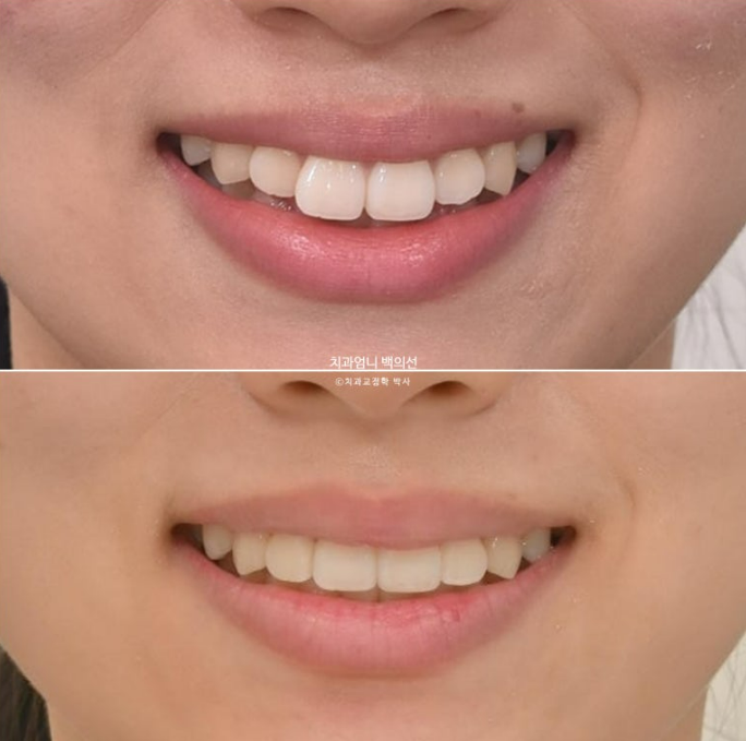 앞니 부분 교정 급속 교정 토끼이빨 MTA 미니튜브 치간삭제 치료기간 9개월 관련 이미지 17