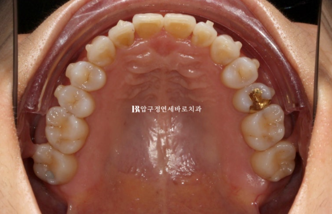 50대 치아교정 후기|잇몸퇴축과 덧니를 개선한 인비절라인 관련 이미지 7