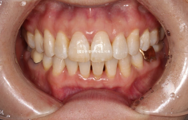 50대 치아교정 인비절라인 라이트 앞니교정 치료 후기 관련 이미지 9