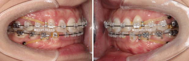 웃을 때 잇몸이 보여요. 잇몸미소 거미스마일 교정하기 관련 이미지 5