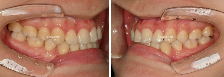 비수술 주걱턱 비대칭 발치 교정 결손치 반대교합 클리피씨 치료기간 1년 11개월 관련 이미지 11