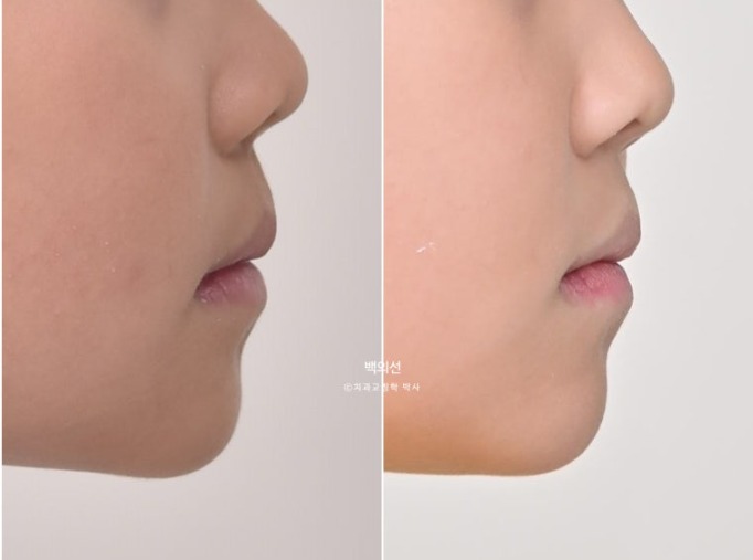 소아 비대칭 교정 인비절라인 퍼스트 재제작 1회 MA 치료 관련 이미지 17