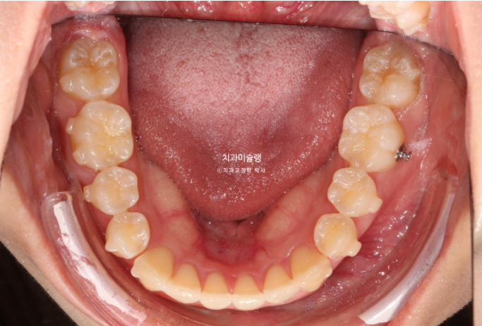 덧니 인비절라인 라이트 잇몸미소 거미스마일 중심선 블랙트라이앵글 관련 이미지 10