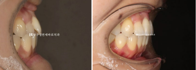 Gangnam Orthodontic Clinic: A Woman in Her 30s’ Rabbit Teeth Correction Review|Six-Month Front Teeth Partial Orthodontic Treatment That Also Improved a Crossbite image 8