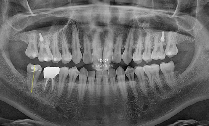 가위교합 나비치아 미니스크류 덧니 교정 인비절라인 라이트 관련 이미지 7