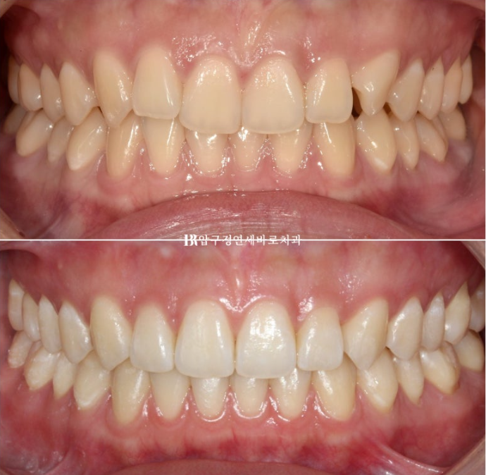 압구정 교정치과 / 옥니교정 인비절라인 라이트 덧니교정 관련 이미지 15