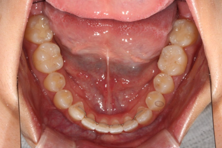 앞니 단기 부분교정 재교정 개방교합 교정 후기 관련 이미지 11