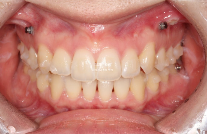 덧니 인비절라인 라이트 잇몸미소 거미스마일 중심선 블랙트라이앵글 관련 이미지 7