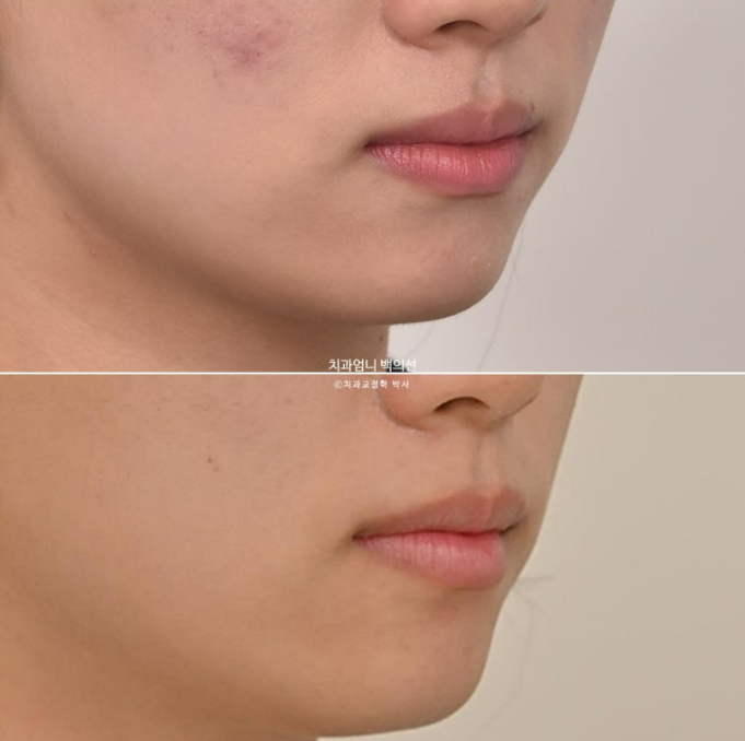 앞니 부분 교정 토끼이빨 덧니교정 ? 관련 이미지 19