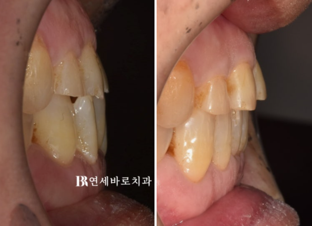 60대 무삭제 라미네이트 앞니 부분교정 치료 관련 이미지 4