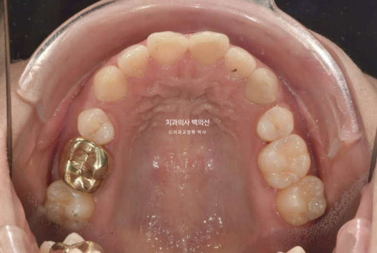 인비절라인 라이트 재교정 발치공간 벌어짐 ? 관련 이미지 3