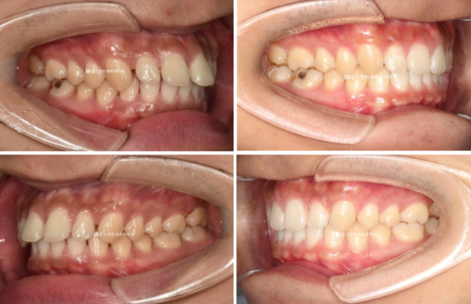 Can Invisalign Fix a Gap Between the Front Teeth? ๐ฎ A Real 9-Month Case Finished Without Remaking Aligners image 7