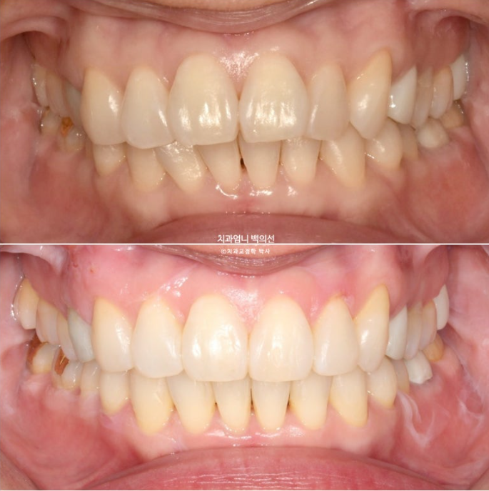 50대 캔팅 교합평면 기울어짐 덧니 교정 인비절라인 라이트 교정? 관련 이미지 10