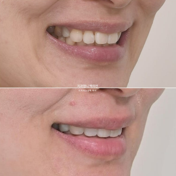50대 치아교정 교합평면 기울어짐 토끼이 덧니 교정? 관련 이미지 15