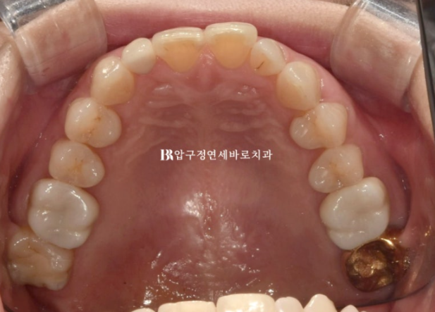 40대 인비절라인 라이트|가위교합도 10개월 만에 개선 가능할까요? 발치 없이 치료한 실제 증례 관련 이미지 5