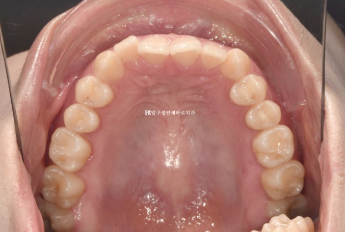 압구정 교정치과 / 옥니교정 인비절라인 라이트 덧니교정 관련 이미지 4
