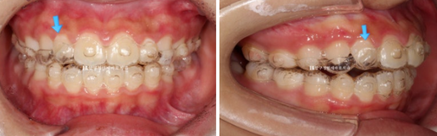 강남 소아교정 인비절라인 퍼스트 어린이 반대교합 관련 이미지 10