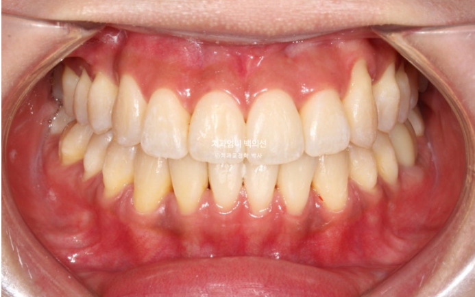 비발치 교정 덧니 인비절라인 교정 절단교합 반대교합 치료기간 1년 6개월 관련 이미지 16